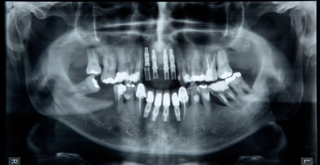 radiografia panoramica