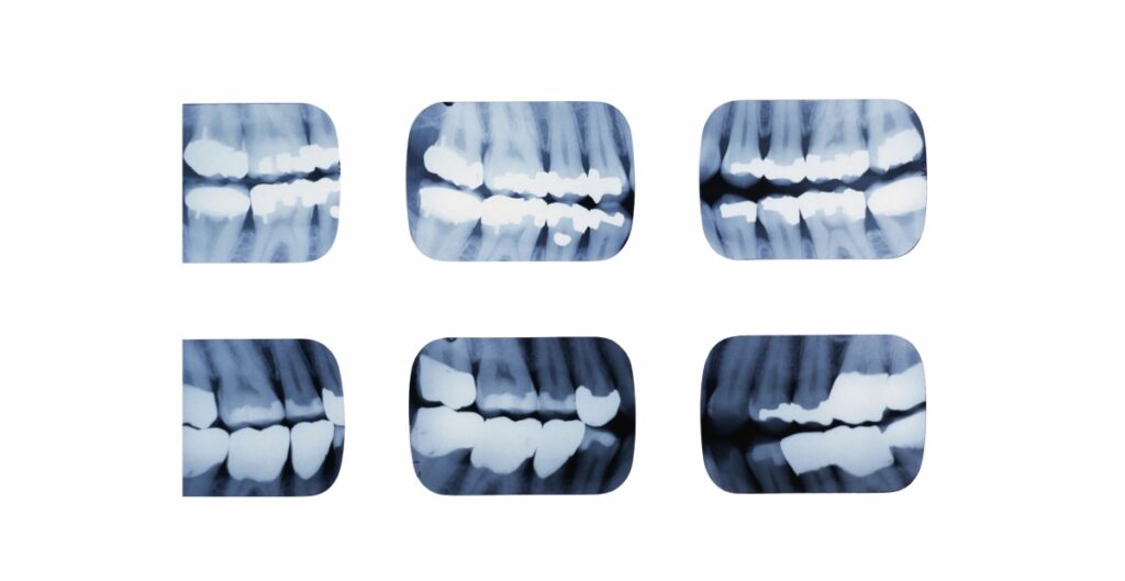 radiografia interproximal