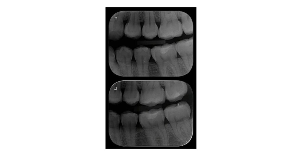 radiografia periapical