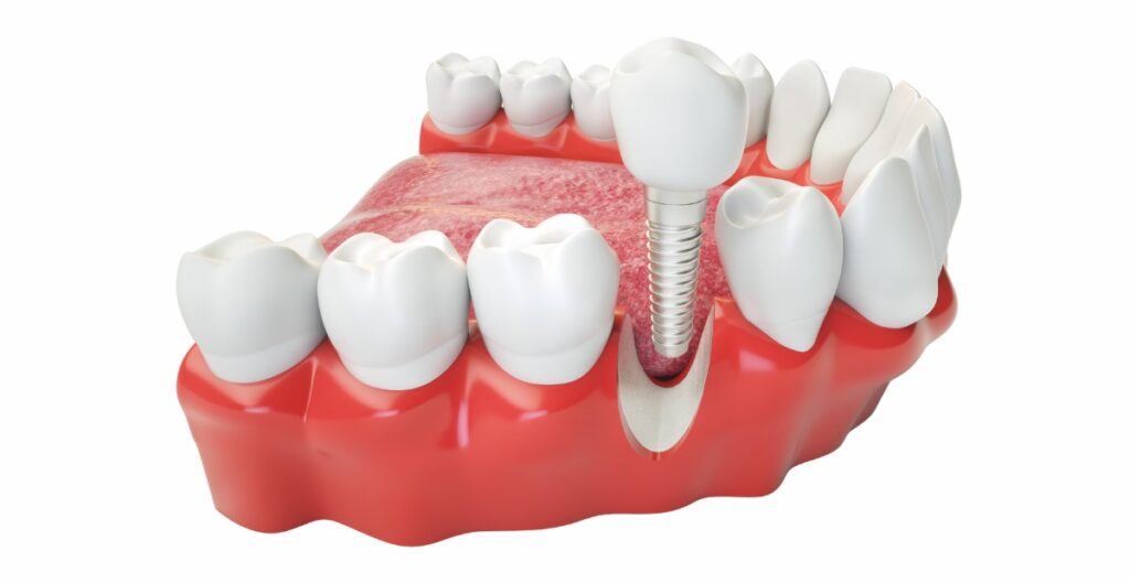 tomografia odontologica implante dentario