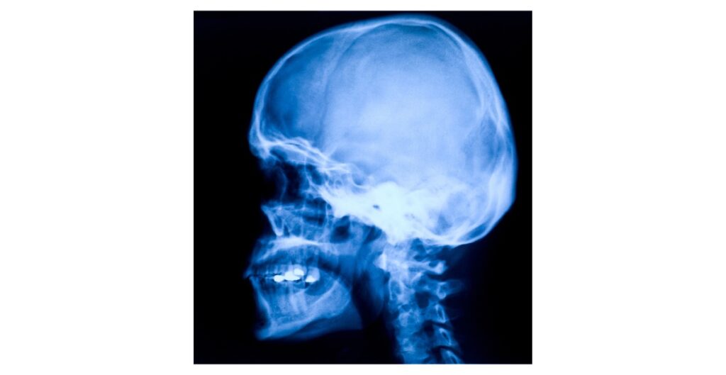 radiografia cavum