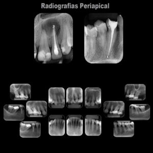 periapical