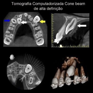 tomografia